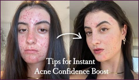 How To Feel Confident With Acne?